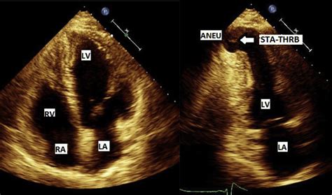 lv aneurysm ecg|lv aneurysm on echo.